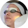 IPL Photofacial